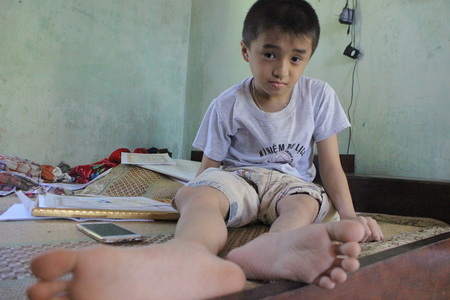 Mới 11 tuổi nhưng Quang đã 17 lần gãy chân do chứng bệnh xương thủy tinh